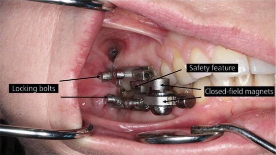 “قفل الأسنان”.. تطوير جهاز يمنع الأكل للقضاء على السمنة