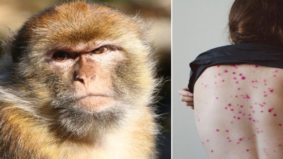 الإمارات ترصد أول حالة مصابة بمرض جدري القردة على أراضيها